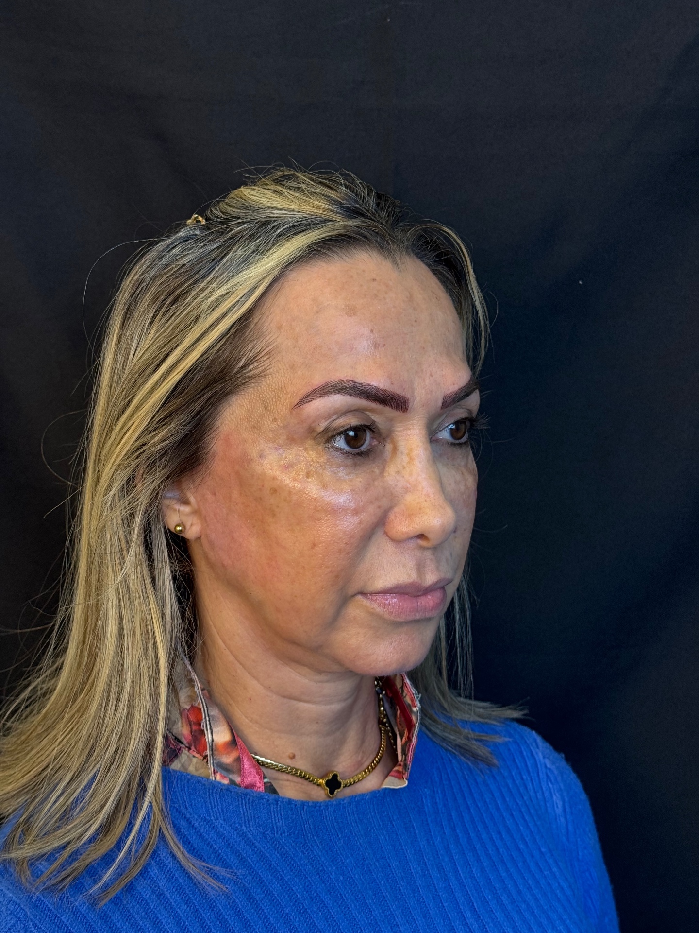 Depois do tratamento na região dos olhos