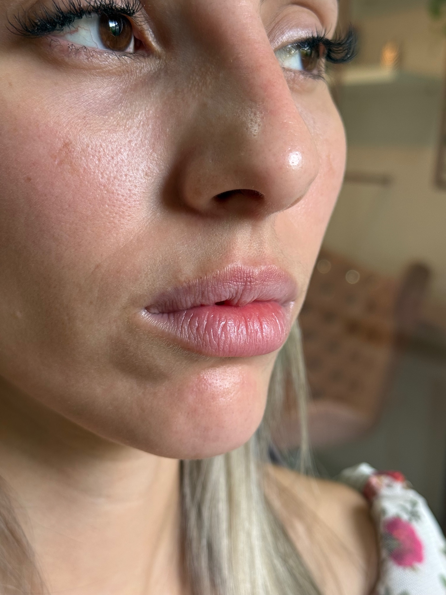 Resultado real de tratamento labial, vista frontal