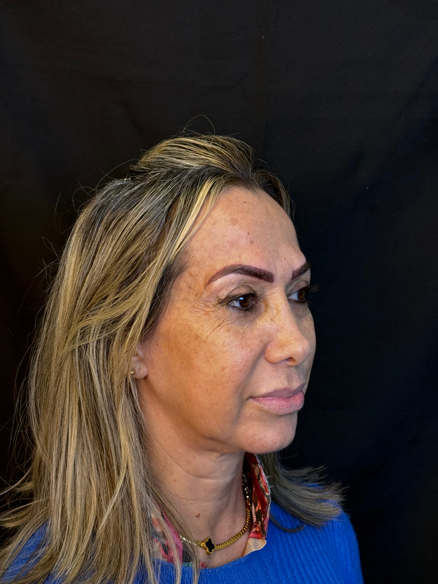 Antes do tratamento na região dos olhos