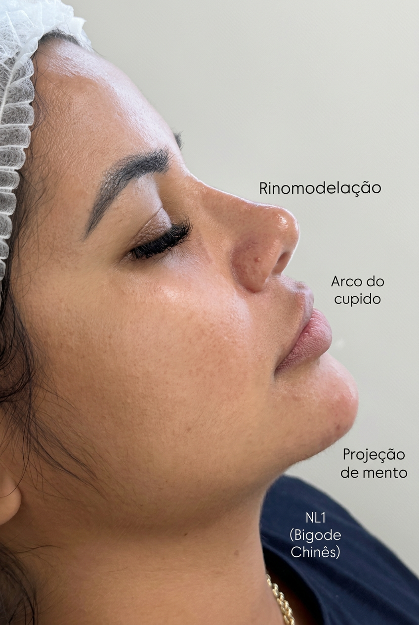 Protocolo Hermes: detalhes da rinomodelação, arco do cupido, projeção de mento e bigode chinês